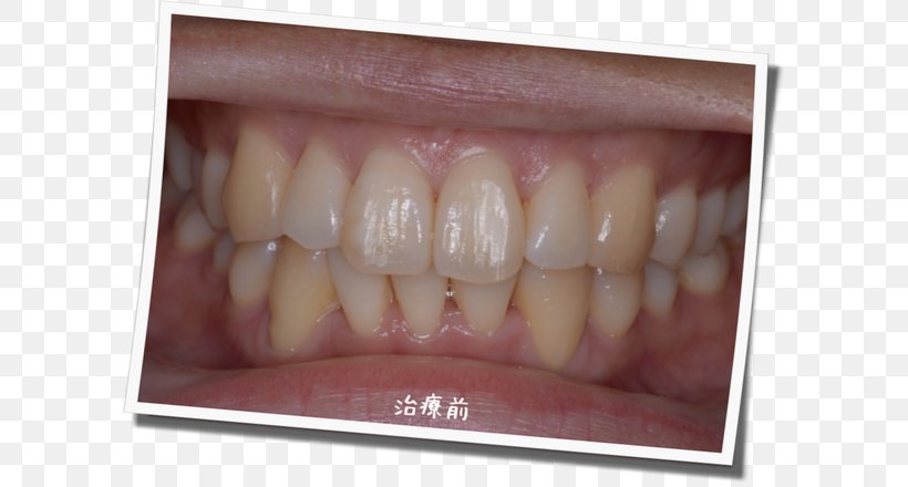 Tooth Whitening 審美歯科 Dentist Gums, PNG, 600x440px, Tooth, Color, Cosmetic Dentistry, Dental Braces, Dentist Download Free
