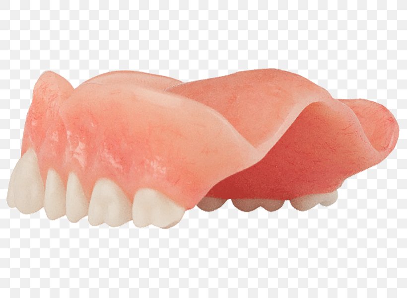 Tooth Dentures Dentistry All-on-4 Dental Implant, PNG, 800x600px, Tooth, Ache, Aspen Dental, Color, Dental Implant Download Free