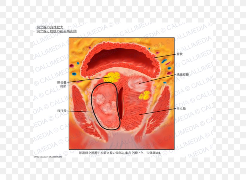 Prostate Imaging Anatomy Magnetic Resonance Imaging Urinary Bladder, PNG, 600x600px, Watercolor, Cartoon, Flower, Frame, Heart Download Free