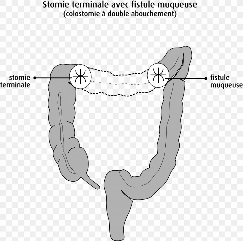 Large Intestine Ileostomy Colostomy Rectum Colorectal Cancer, PNG, 1261x1249px, Watercolor, Cartoon, Flower, Frame, Heart Download Free