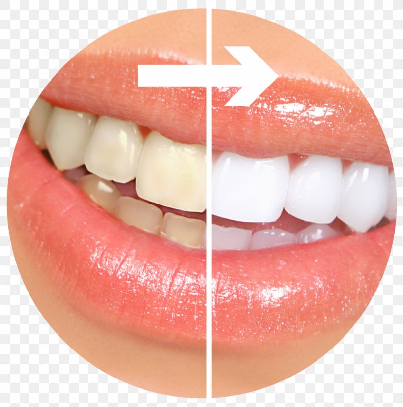 Tooth Whitening Cosmetic Dentistry Human Tooth, PNG, 1013x1024px, Tooth Whitening, Clear Aligners, Cosmetic Dentistry, Crown, Dental Implant Download Free