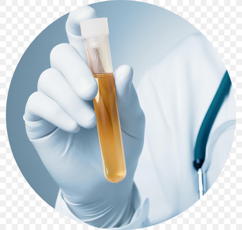 Clinical Urine Tests Urinary Tract Infection Bladder Cancer Olfaction, PNG, 780x780px, Urine, Bladder Cancer, Clinical Urine Tests, Detoxification, Drug Download Free