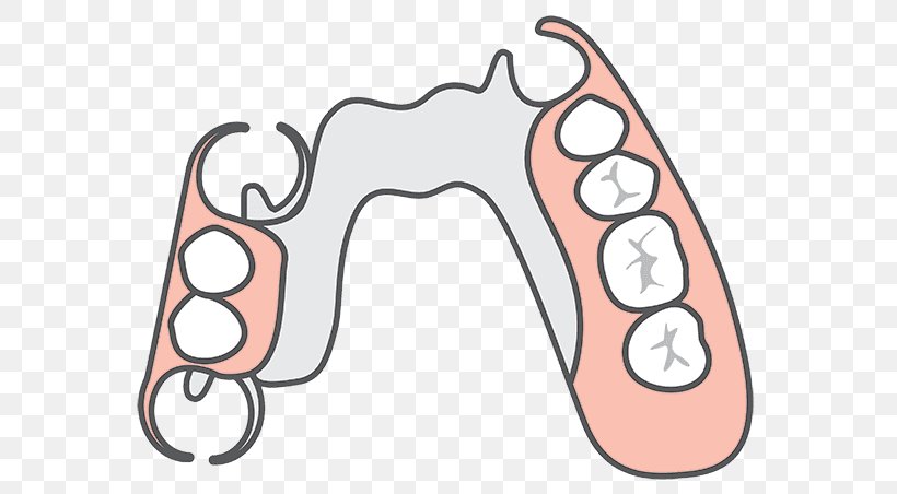 Mouth Cartoon, PNG, 600x452px, Removable Partial Denture, Bridge, Complete Dentures, Dental Implant, Dental Prosthesis Download Free