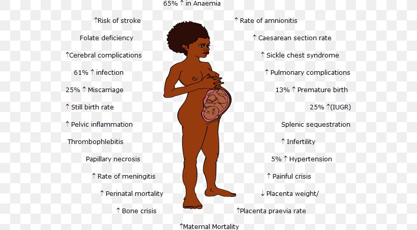 Sickle Cell Disease Pregnancy Anemia, PNG, 561x452px, Watercolor