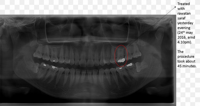 Wisdom Tooth Toothache Root Canal Jaw, PNG, 1600x852px, Wisdom Tooth, Black And White, Clinic, Common Cold, Gums Download Free