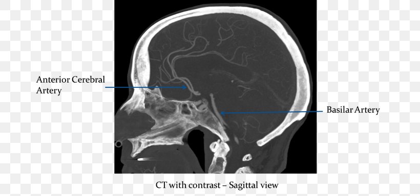 Computed Tomography Circle Of Willis Sagittal Plane Brain Intracranial Aneurysm, PNG, 700x384px, Computed Tomography, Anatomy, Aneurysm, Anterior Cerebral Artery, Artery Download Free