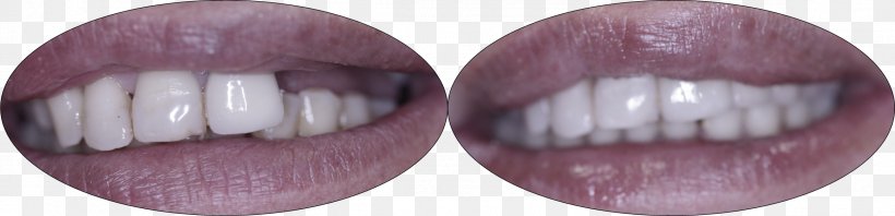 Dentistry Bridge Crown Dental Implant Eye, PNG, 2327x564px, Watercolor, Cartoon, Flower, Frame, Heart Download Free
