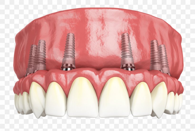 Hybridge Dental Implants Giesy Family And Implant Dentistry, PNG, 1914x1286px, Watercolor, Cartoon, Flower, Frame, Heart Download Free