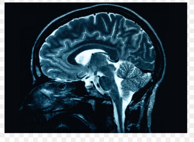 Human Brain X-ray Head Injury Medicine, PNG, 1115x815px, Watercolor, Cartoon, Flower, Frame, Heart Download Free