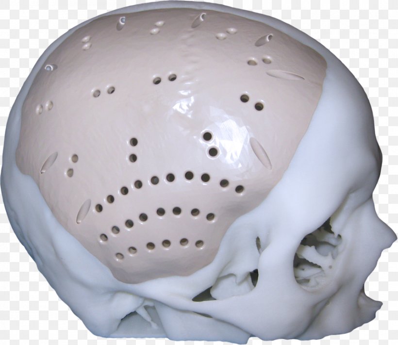Jaw Implant Skull Cranioplasty Surgery, PNG, 891x773px, 3d Printing, Jaw, Bone, Cranioplasty, Decompressive Craniectomy Download Free
