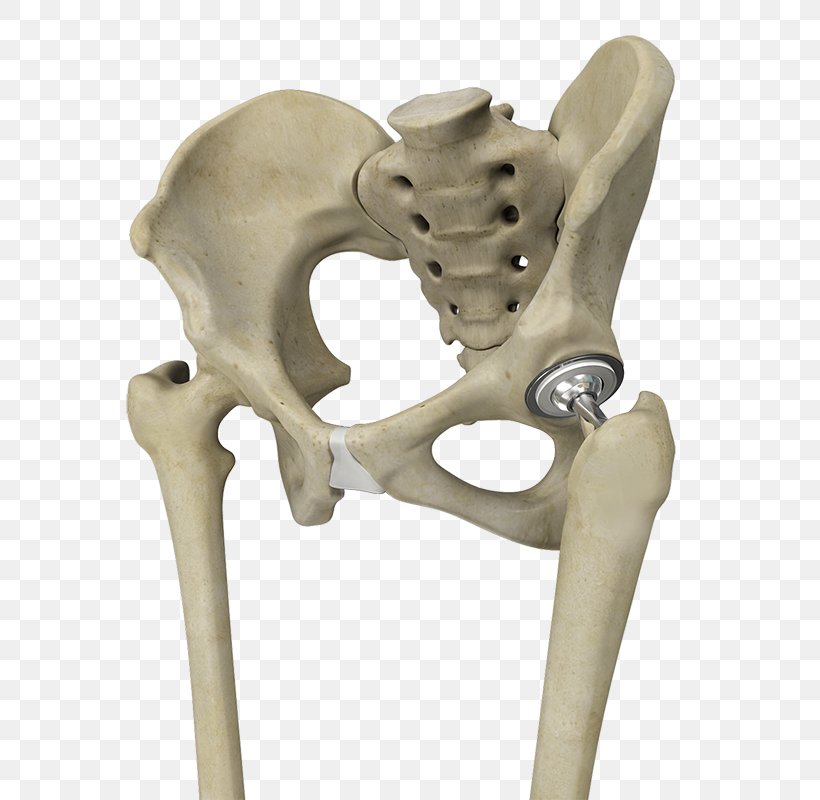Hip Replacement Joint Replacement Surgery Knee Replacement, PNG, 800x800px, Hip Replacement, Acetabulum, Arthroplasty, Bone, Bone Fracture Download Free