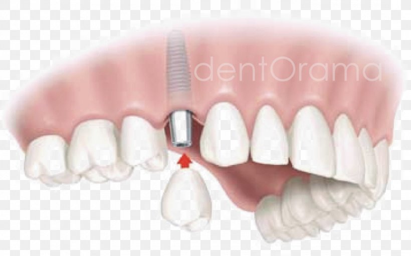 Dental Implant Dentistry Edentulism Tooth, PNG, 1080x675px, Dental Implant, Bridge, Cosmetic Dentistry, Dental Surgery, Dentist Download Free
