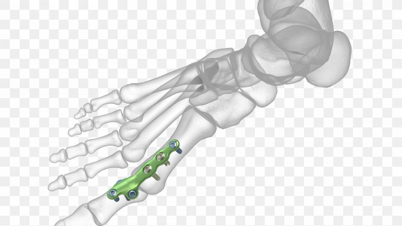 Thumb Metatarsophalangeal Joints Arthrodesis Surgery, PNG, 4000x2250px, Thumb, Ankle, Arm, Arthrodesis, Bone Download Free