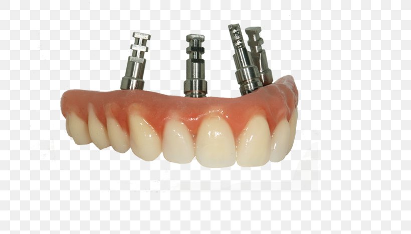 Bridge Tooth Dentures Prosthesis Dentistry, PNG, 700x467px, Bridge, Crown, Dental Implant, Dental Laboratory, Dentistry Download Free