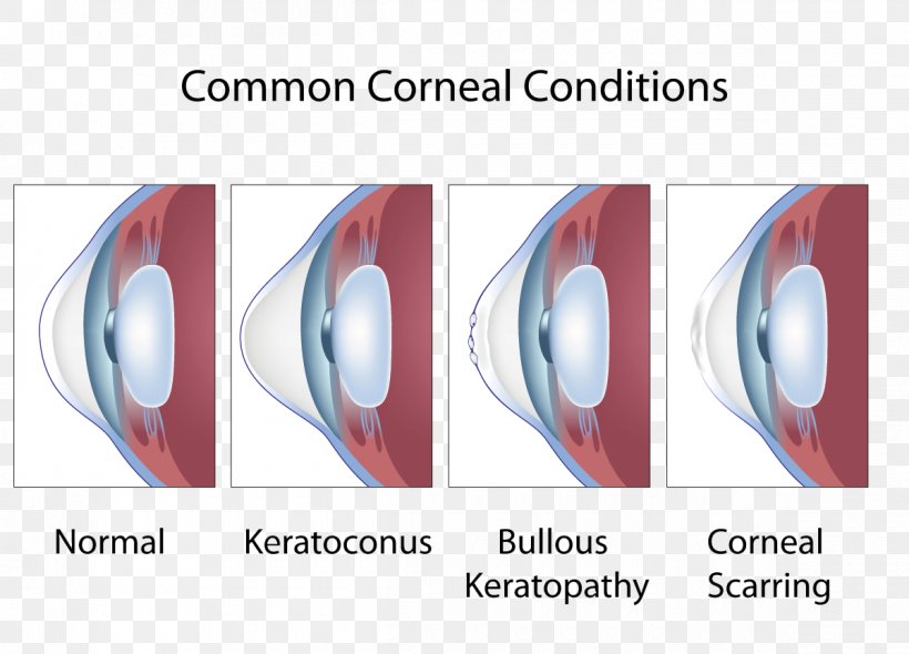 Keratoconus Cornea Symptom Eye Ophthalmology, PNG, 1200x864px, Keratoconus, Allergy, Contact Lenses, Cornea, Disease Download Free