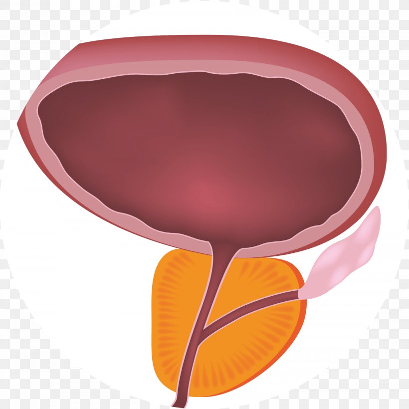 Benign Prostatic Hyperplasia Prostate Lower Urinary Tract Symptoms Benignity, PNG, 1804x1806px, Benign Prostatic Hyperplasia, Benign Tumor, Benignity, Disease, Hyperplasia Download Free