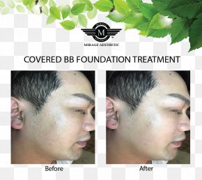 Face - Laser Surgery Therapy Face Scar PNG