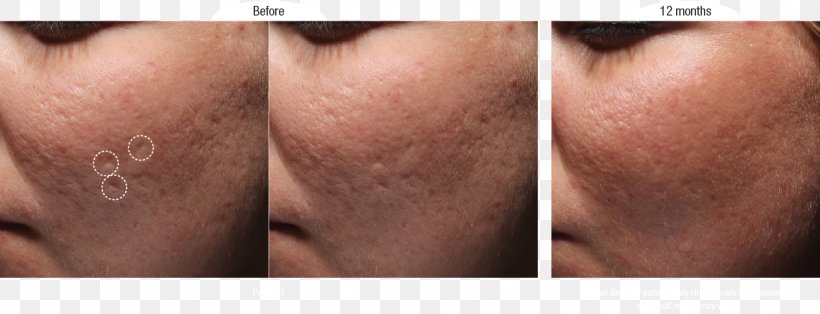 Scar Acne Collagen Induction Therapy Lip Skin, PNG, 1264x485px, Scar, Acne, Cheek, Chin, Close Up Download Free