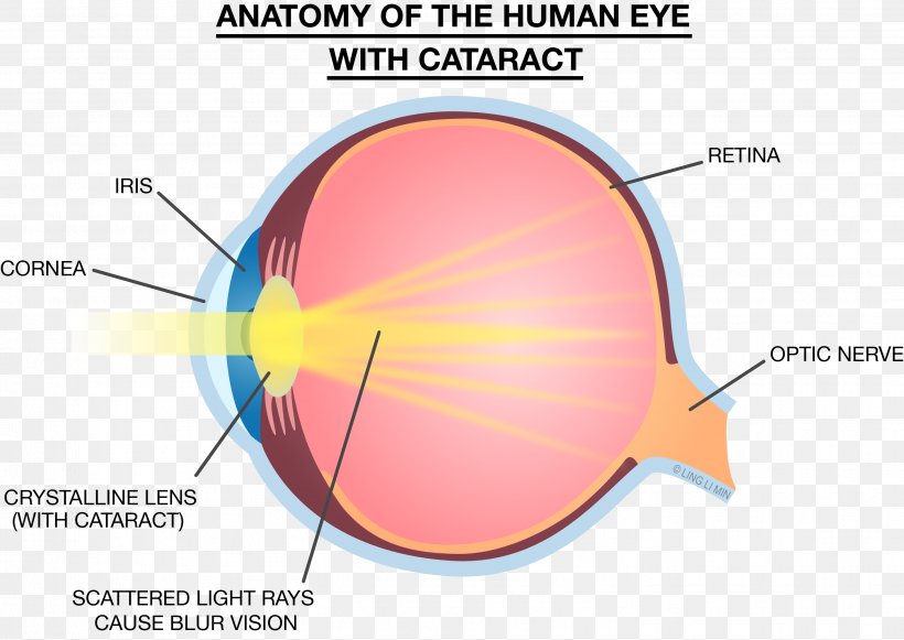 Light Eye Lens Strength Training Anatomy Cataract, PNG, 2906x2062px, Watercolor, Cartoon, Flower, Frame, Heart Download Free