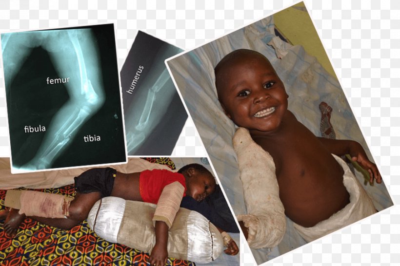 Child Tibia Bone Fracture Femur, PNG, 900x600px, Child, Bone, Bone Fracture, Car, Femur Download Free