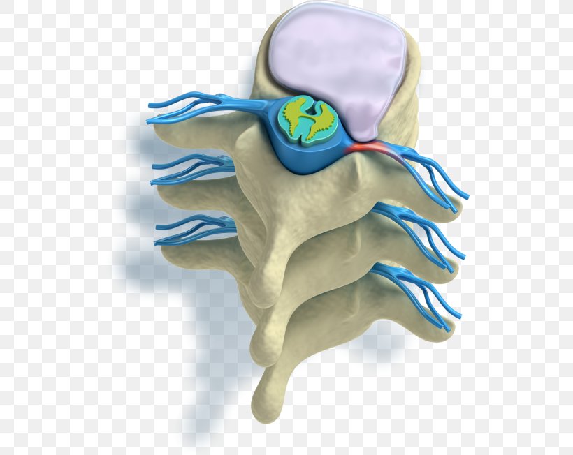 Pain In Spine Vertebral Column Spinal Disc Herniation Radicular Pain Intervertebral Disc, PNG, 524x652px, Watercolor, Cartoon, Flower, Frame, Heart Download Free
