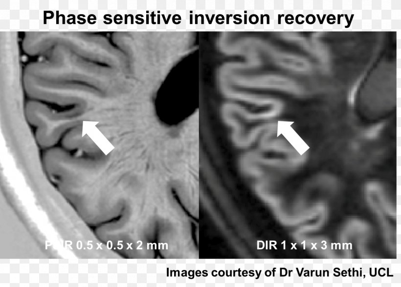 Multiple Sclerosis Magnetic Resonance Imaging Depression Cognitive Disorder Disease, PNG, 1248x895px, Multiple Sclerosis, Black And White, Brain, Close Up, Cognition Download Free