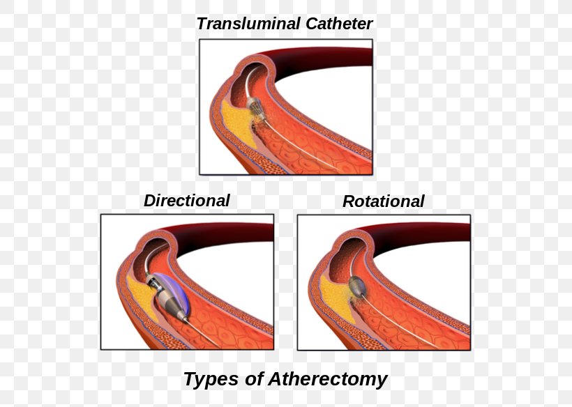Atherectomy Peripheral Artery Disease Surgery Cleveland Clinic, PNG, 599x584px, Atherectomy, Arteriosclerosis, Artery, Blood Vessel, Catalan Wikipedia Download Free