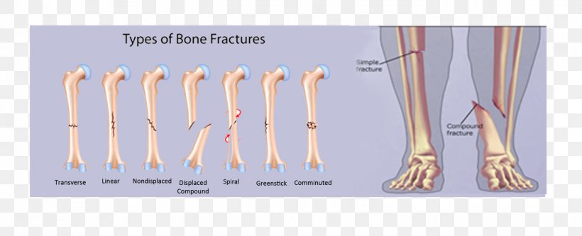 Bone Fracture Comminution Joint Pathologic Fracture, PNG, 1446x588px, Bone Fracture, Bone, Brand, Cartoon, Clavicle Download Free