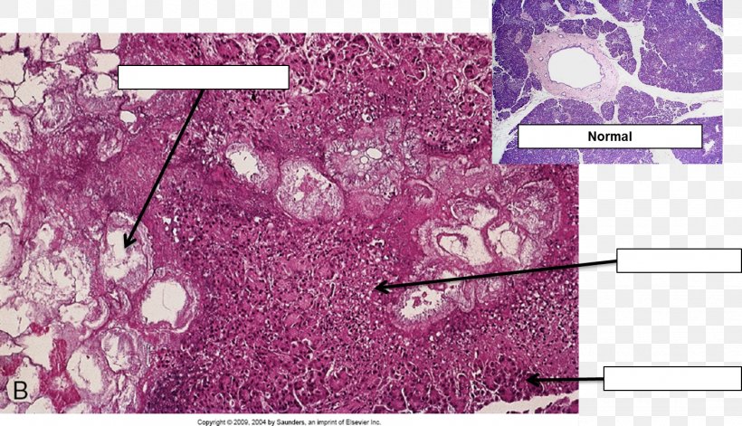 Acute Pancreatitis Histopathology Histology Necrosis Acute Disease, PNG, 1413x813px, Watercolor, Cartoon, Flower, Frame, Heart Download Free