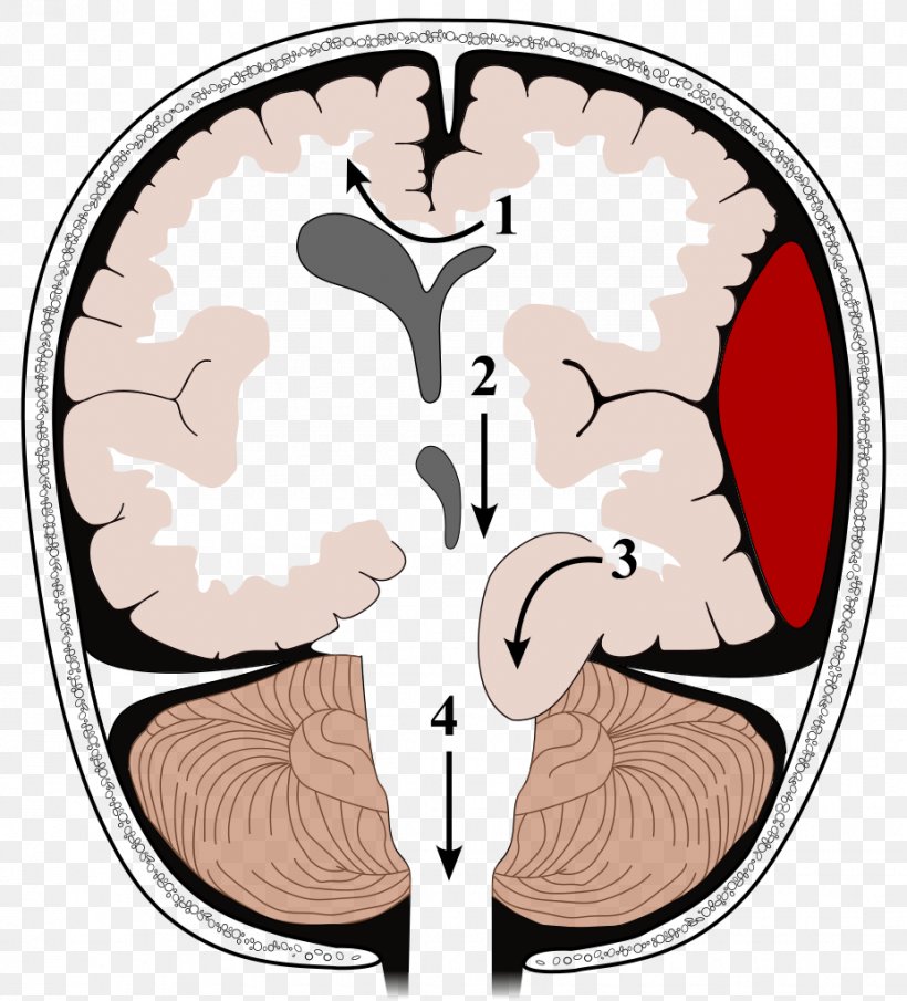 Brain Herniation Intracranial Pressure Traumatic Brain Injury Kernohan's Notch, PNG, 927x1024px, Watercolor, Cartoon, Flower, Frame, Heart Download Free