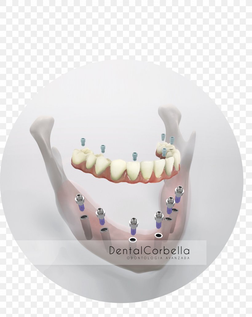 Human Tooth Dental Implant Dentistry Dentures, PNG, 1467x1843px, Human Tooth, Cake, Dental Implant, Dentistry, Dentures Download Free