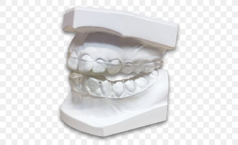 Jaw Tooth Bruxism Dentistry Splint, PNG, 500x500px, Jaw, Abfraction, Bruxism, Dental Laboratory, Dentist Download Free