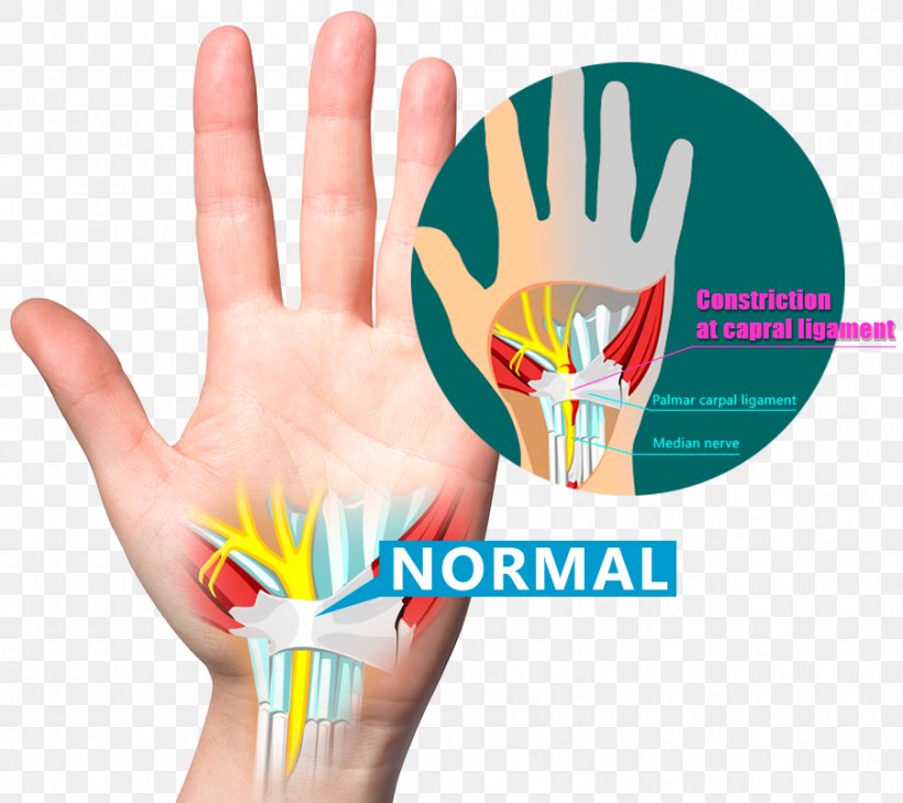 Wrist Pain Carpal Bones Carpal Tunnel Syndrome Ligament, PNG, 901x802px, Wrist Pain, Ache, Bone, Carpal Bones, Carpal Tunnel Download Free