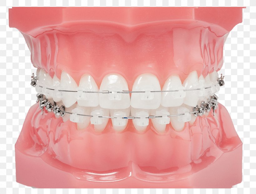 Damon System Clear Aligners Dental Braces Orthodontics Dentistry, PNG, 826x625px, Damon System, Clear Aligners, Cosmetic Dentistry, Crossbite, Dental Braces Download Free