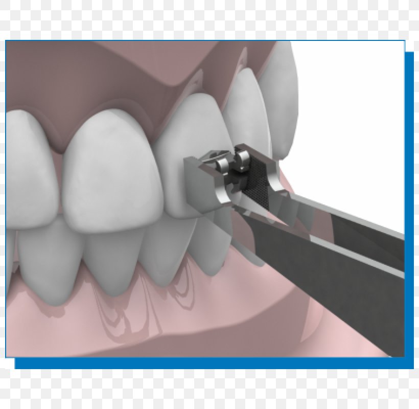 Dental Braces Orthodontics Tweezers Tooth Dentistry, PNG, 800x800px, Dental Braces, Dentistry, Ebay, Health, Jaw Download Free