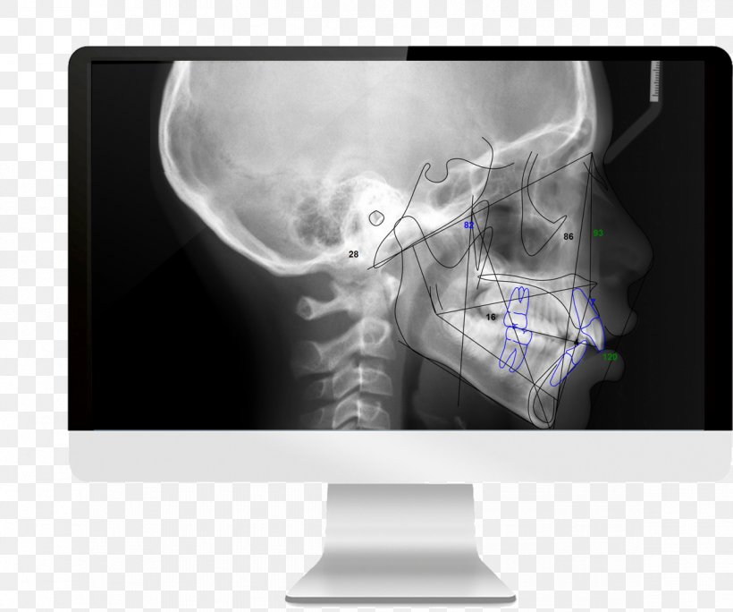 Medical Imaging Cone Beam Computed Tomography Radiography, PNG, 1172x978px, Medical Imaging, Bone, Cervical Vertebrae, Computed Tomography, Cone Beam Computed Tomography Download Free