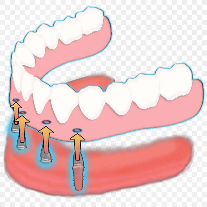 Tooth Mini Dental Implants: Principles And Practice Complete Dentures, PNG, 1000x1000px, Watercolor, Cartoon, Flower, Frame, Heart Download Free