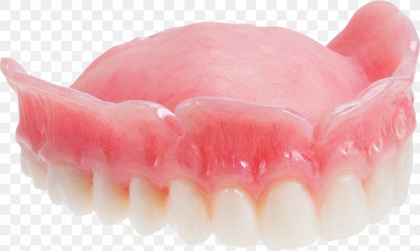 Dentures Dentistry Maxilla Tooth Dental Implant, PNG, 1000x600px, Dentures, Dental Implant, Dental Laboratory, Dentist, Dentistry Download Free