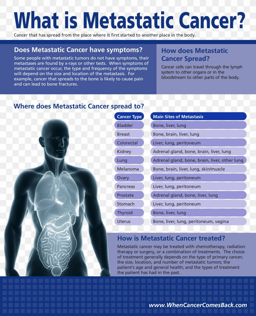 Reno CyberKnife Metastasis Cancer Radiosurgery, PNG, 2550x3147px, Metastasis, Advertising, Brain, Brain Metastasis, Breast Cancer Download Free