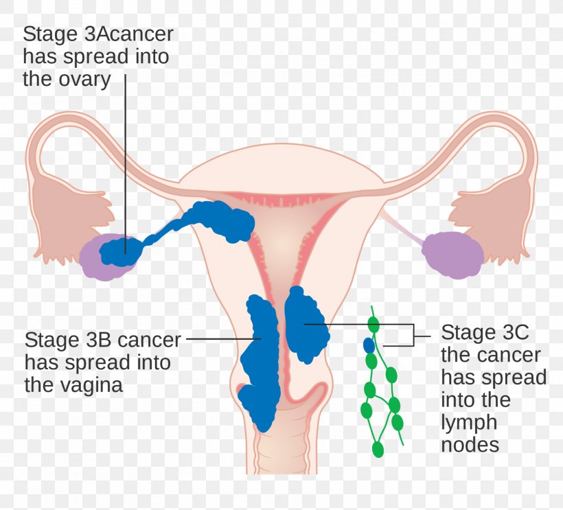 Uterine Cancer Endometrial Cancer Endometrium Cancer Staging, PNG, 1600x1450px, Watercolor, Cartoon, Flower, Frame, Heart Download Free