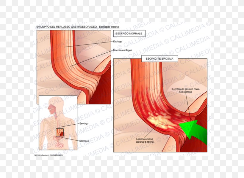 Gastroesophageal Reflux Disease Esophagus Esophagitis Cough, PNG, 600x600px, Watercolor, Cartoon, Flower, Frame, Heart Download Free