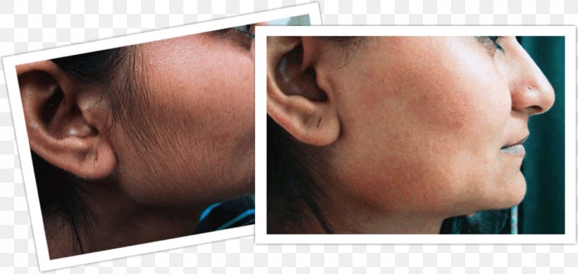 Hair Removal Facial Hair Woman Human Hair Growth, PNG, 1500x715px, Hair Removal, Body Hair, Cheek, Chin, Ear Download Free