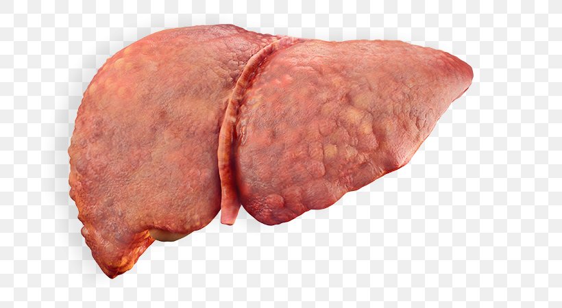 Alcoholic Liver Disease Cirrhosis Fatty Liver, PNG, 700x450px, Watercolor, Cartoon, Flower, Frame, Heart Download Free
