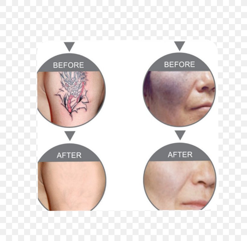 Nd:YAG Laser Tattoo Removal Photorejuvenation Laser Hair Removal, PNG, 800x800px, Ndyag Laser, Cheek, Chin, Ear, Facial Rejuvenation Download Free