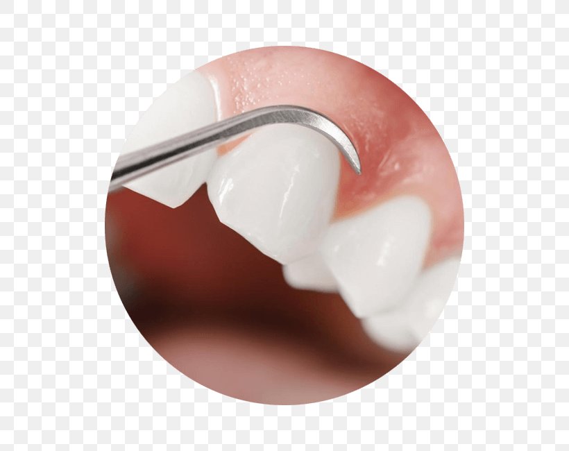 Gums Periodontal Disease Gingivitis Gingival Recession Dental Calculus, PNG, 650x650px, Gums, Bleeding On Probing, Dental Calculus, Dental Plaque, Dentist Download Free