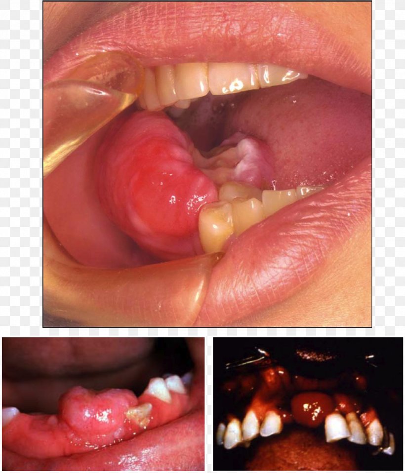 Odontogenic Cyst Peripheral Odontogenic Fibroma Peripheral Ossifying Fibroma, PNG, 1247x1457px, Odontogenic Cyst, Close Up, Cyst, Fibroma, Jaw Download Free