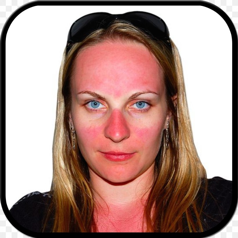 Sunburn Skin Face, PNG, 1024x1024px, Sunburn, Brown Hair, Burn, Can Stock Photo, Cheek Download Free