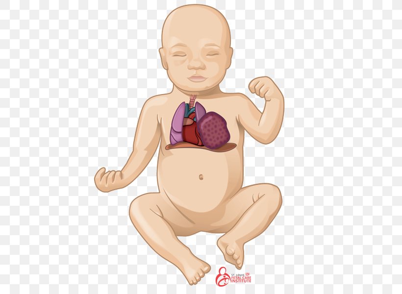 Pulmonary Hypoplasia Lung Congenital Pulmonary Airway Malformation Pulmonary Sequestration, PNG, 600x600px, Watercolor, Cartoon, Flower, Frame, Heart Download Free