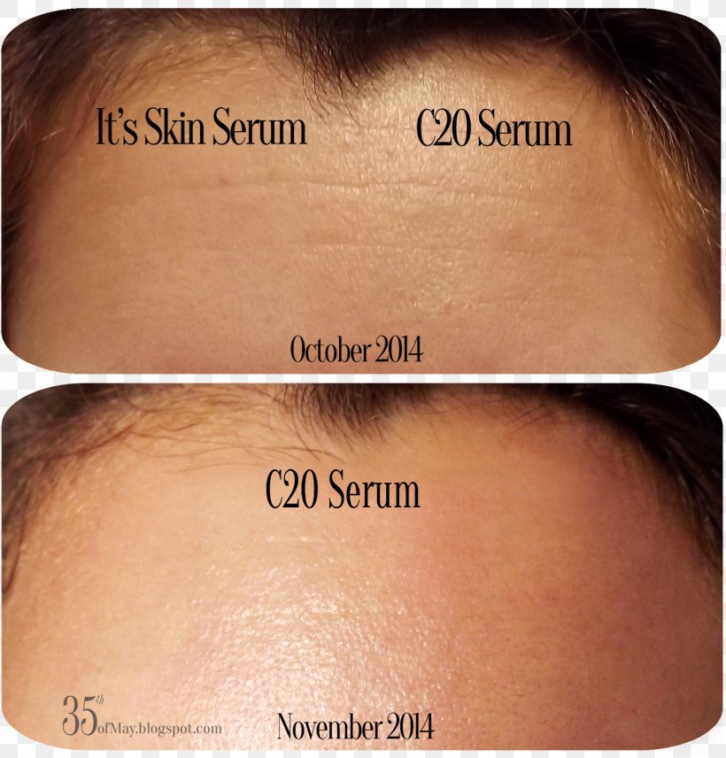 Wrinkle Vitamin C Serum Skin, PNG, 1531x1600px, Wrinkle, Acne, Antiaging Cream, Cheek, Chin Download Free