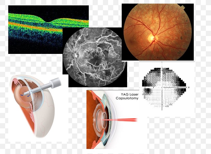 Plastic Cataract Surgery, PNG, 800x600px, Plastic, Cataract, Cataract Surgery, Surgery Download Free